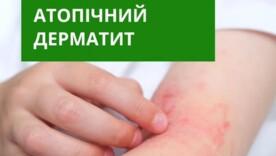 Наука проти міфів: чи справді дієта лікує атопічний дерматит? Наука проти міфів: чи справді дієта лікує атопічний дерматит?