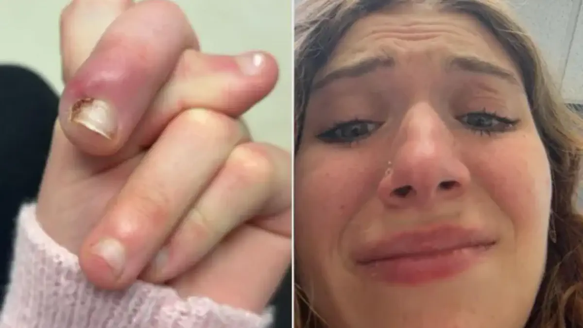 Цена незаметной распространенной привычки: как девушка чуть не потеряла палец