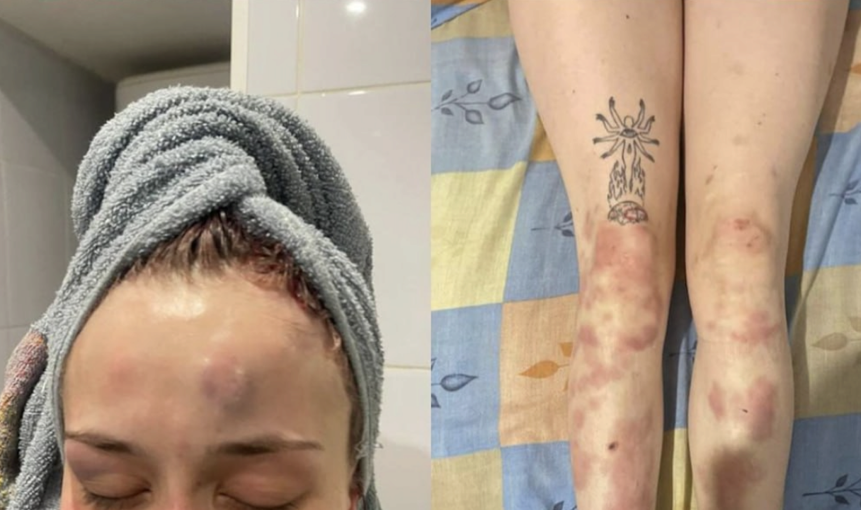 В Одесі, імовірно, представник ТЦК жорстоко побив дівчину: зʼявилась офіційна реакція. Фото 18+