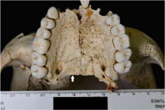 Археологи обнаружили 200-летний череп прокаженной женщины/Фото: Sciencedirect Археологи обнаружили 200-летний череп прокаженной женщины
