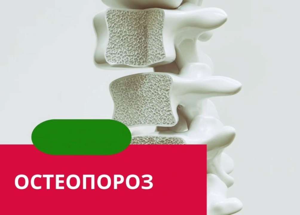 Остеопороз: хто в групі ризику? Які нутрієнти потрібні для міцних кісток? Остеопороз: хто в групі ризику? Які нутрієнти потрібні для міцних кісток?