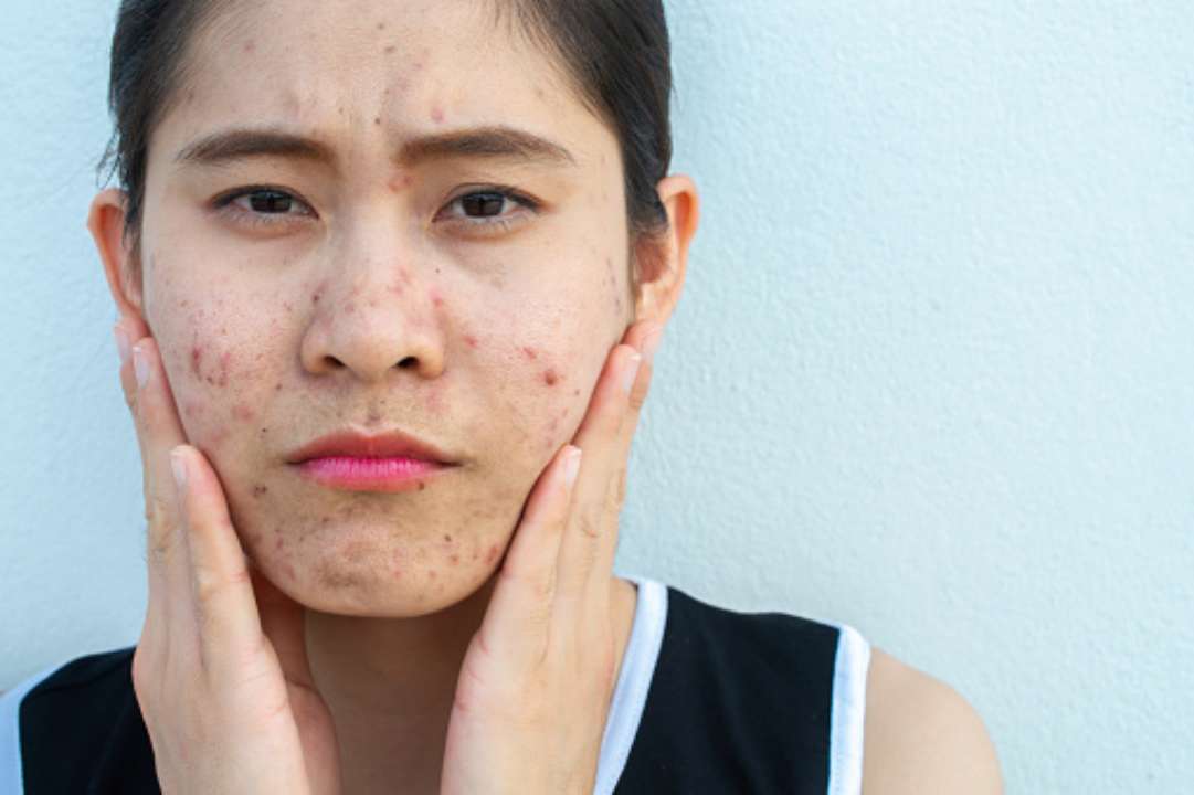 4 пищевых привычки для того, чтобы избежать акне\Фото: Getty image 4 пищевых привычки для того, чтобы избежать акне\Фото: Getty image