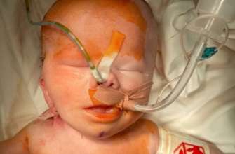 Фото: Інститут педіатрії, акушерства та гінекології НАМН України for Facebook В Україні вперше провели операцію з видалення пухлини на голові у дитини