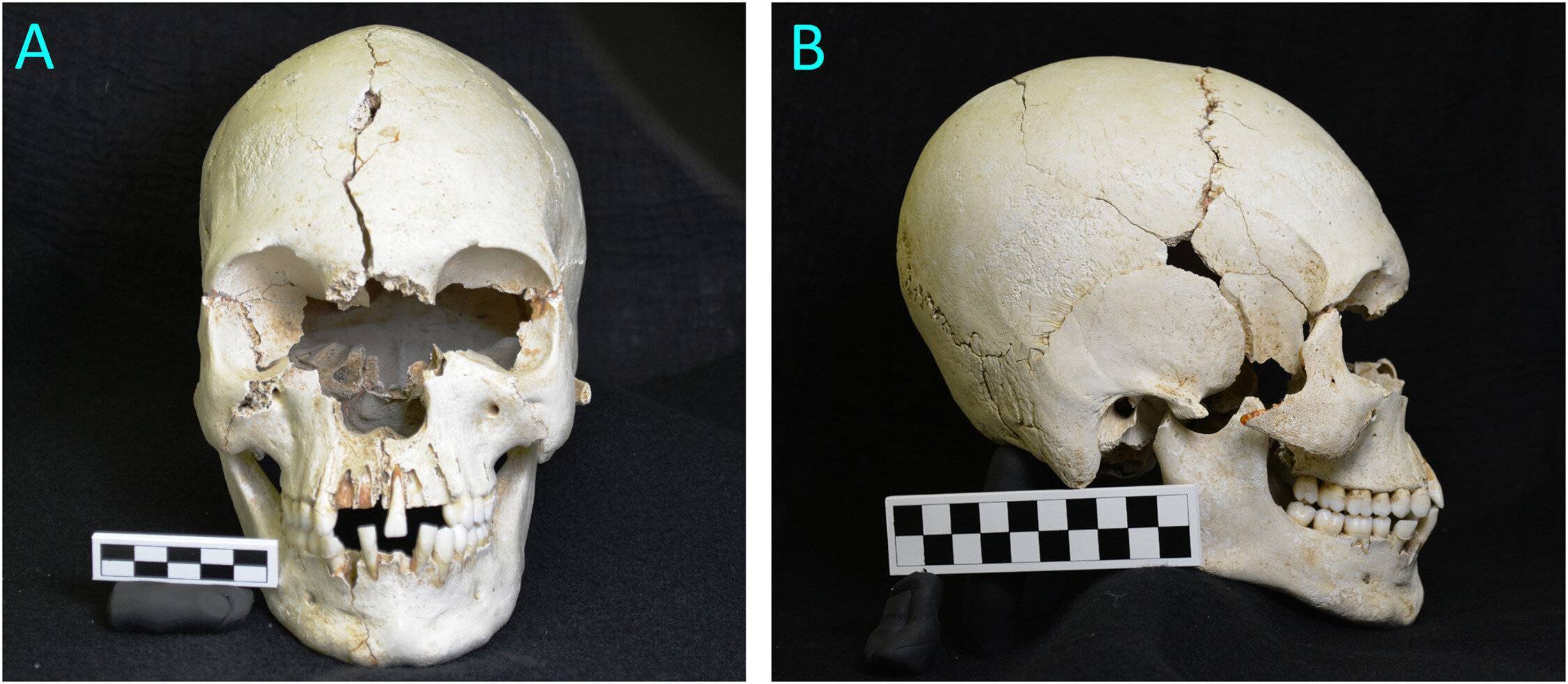 Археологи обнаружили 200-летний череп прокаженной женщины/Фото: Sciencedirect Археологи обнаружили 200-летний череп прокаженной женщины